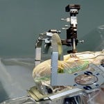 The image shows a patient undergoing surgery for a deep brain stimulation implant.