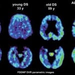 down-syndrome-plaques-tangles