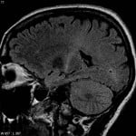 The image shows a coronal view of a brain scan of a person with ALS.