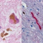 The image shows a histological sample of Substantia nigra in Parkinson's disease.