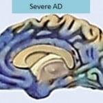 The image shows a brain affected by severe alzheimer's disease.