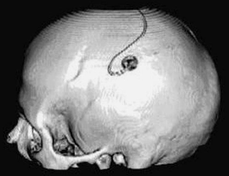 A skull is shown with an electrode on it.