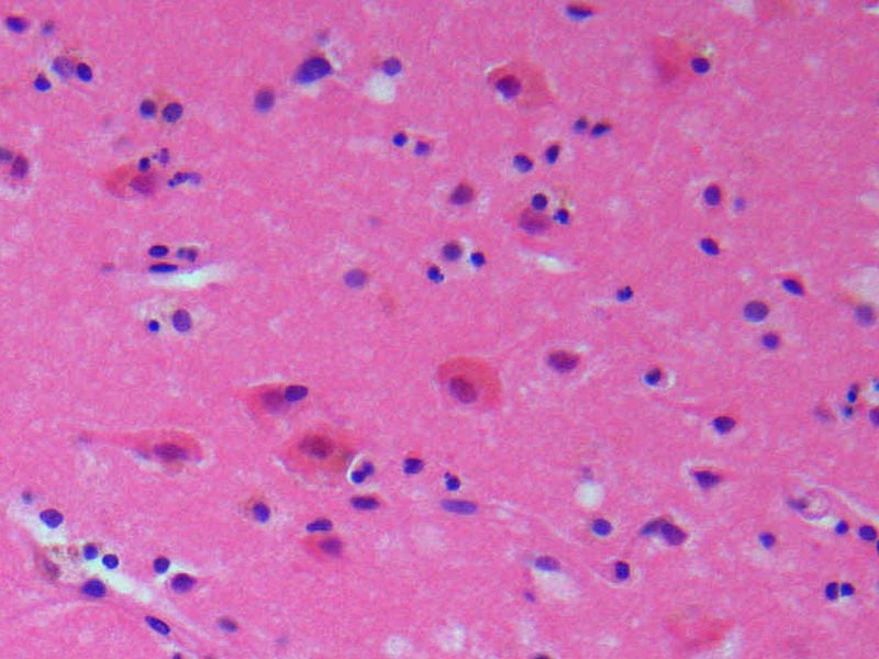Microphotographic image of stained section of brain after an accute stroke.