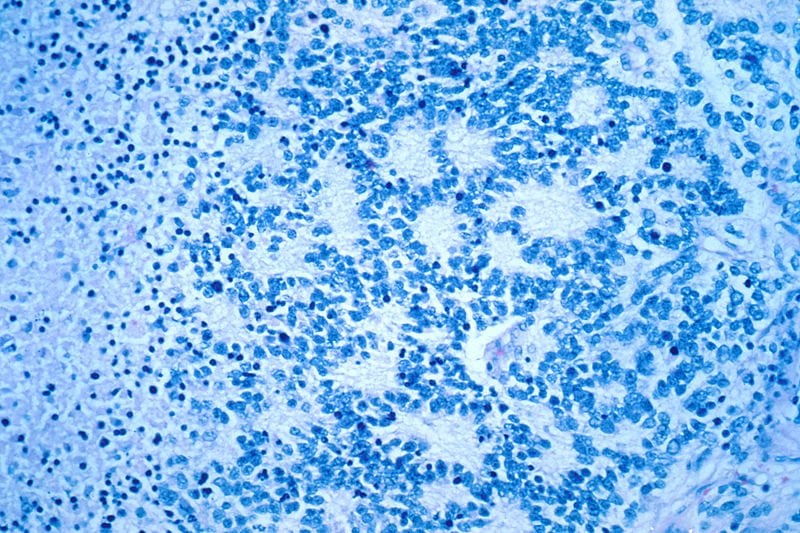 The image shows a microscopic view of a typical neuroblastoma with rosette formation.