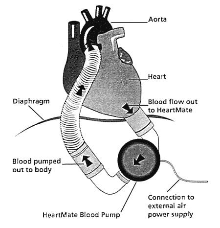 The image shows a sketch of a heart with a left ventricular assist device (LVAD).
