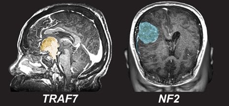 The image shows scans of brains with tumors.