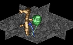 The image shows an over-sized terminal forms a synapse with a dendritic spine. The caption best describes the image.