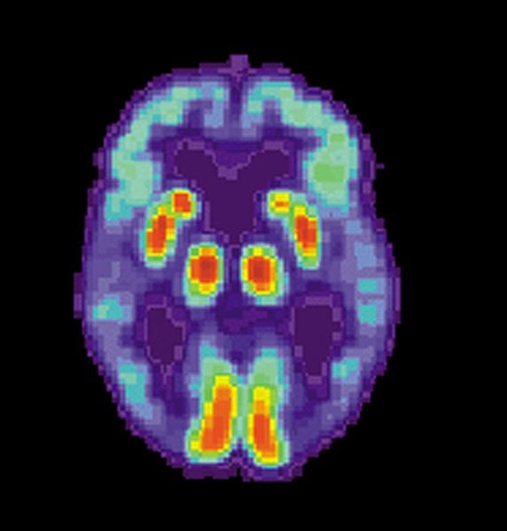 The image shows a PET scan of a brain of a person with Alzheimer's disease.
