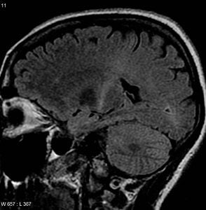 The image shows a coronal  MRI scan of a patient with ALS.