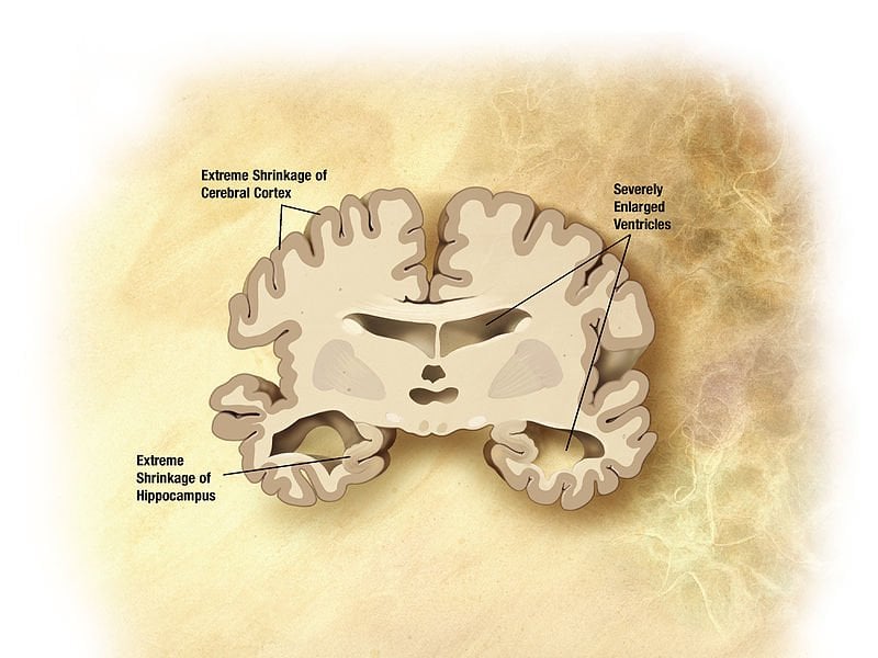 The image is a drawing of a brain slice with alzheimer's disease.