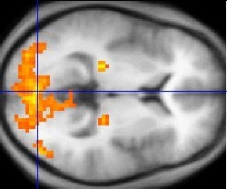 The FMRI image shows regions of activation including primary visual cortex (V1, BA17), extrastriate visual cortex and lateral geniculate body.
