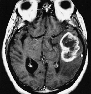 The image shows an MRI scan of a glioblastoma multiforme in a human brain.