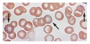 The image shows a close up of blood cells, some of which have evidence of increased levels of lead.