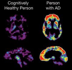 The image shows a comparative brain PET scan of a person with alzheimer's and one without the disease.