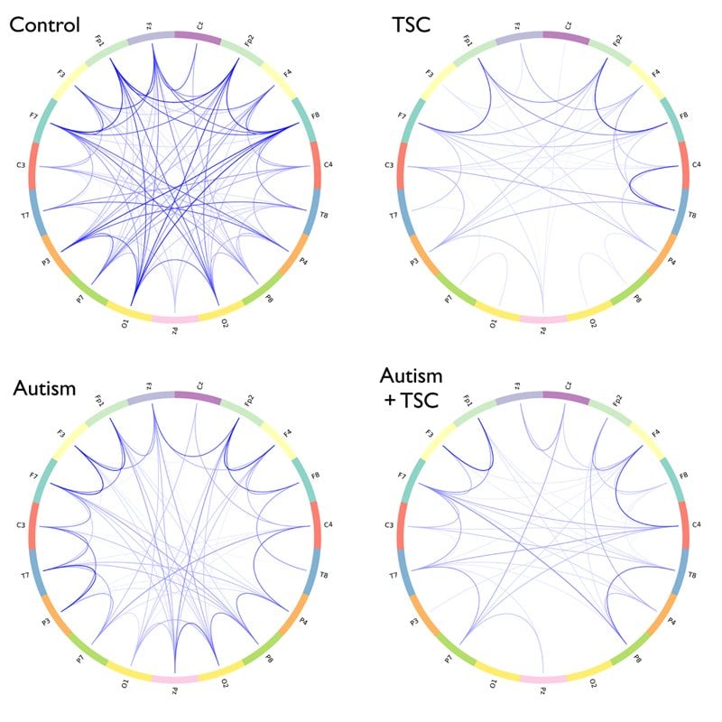 The image shows diagrams of the brain connectivity in children with autism and children without. The caption best describes the image.