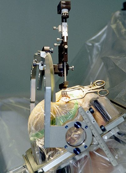 The image shows a person undergoing a deep brain stimulation implant surgery.