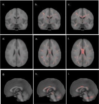 The image shows comparative brain scans of veterans with mild TBI and those without TBI.