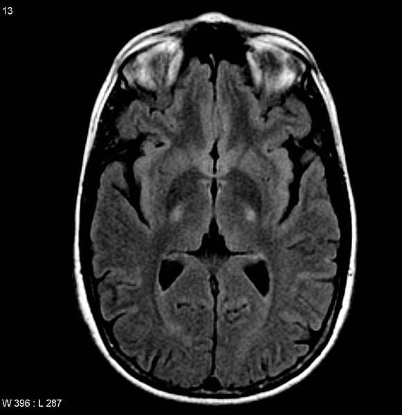 The image shows a brain MRI of a patient with ALS.