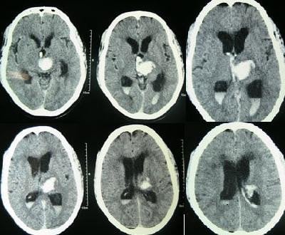 The image is a CT scan of intracerebral hemorrhage.