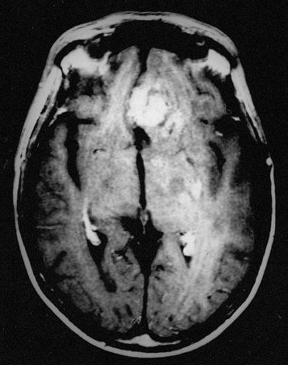 The image is a brain scan of a patient with recurrent glioblastoma.