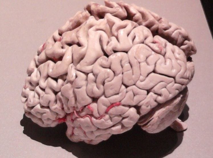 The image is a plastinated brain of a person with Alzheimer's disease.