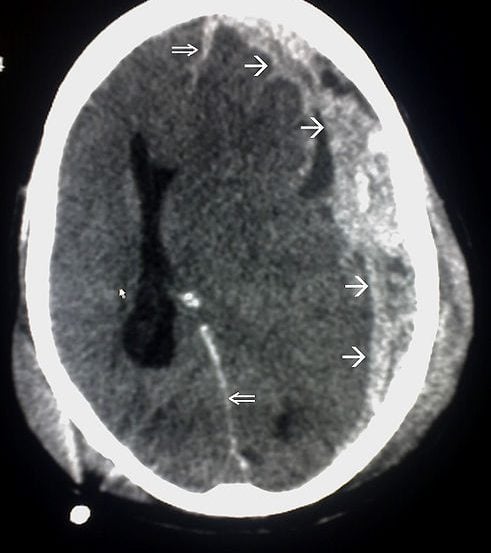 The image shows a CT scan is an example of Subdural haemorrhage caused by trauma.