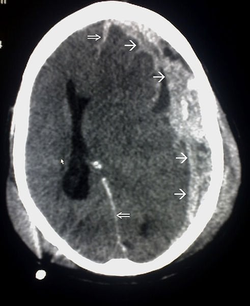 The image shows a CT scan is an example of Subdural haemorrhage caused by trauma.