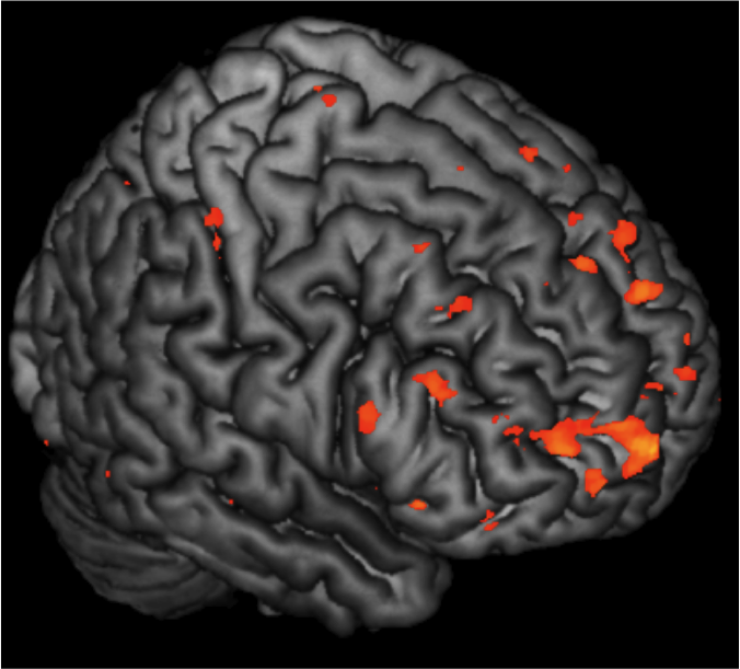 The image shows the brain activation in children with a family history of schizophrenia, who are themselves at greater risk for developing schizophrenia.