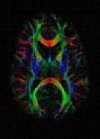 The image shows a color map of the brain from a dMRI scan.