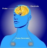 The image is an illustration of a deep brain stimulation device fitted.