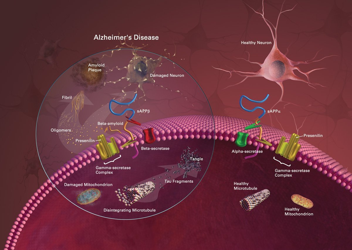 The image is a diagram comparing the difference between neuron damage and associated damage in alzheimer's disease with normal neurons.