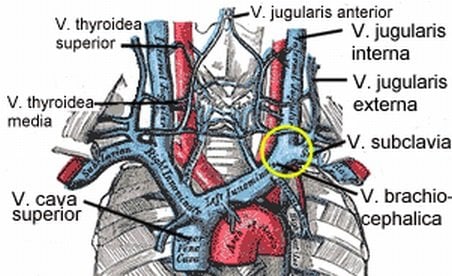 The image shows a diagram of veins in the neck which are affected by CCSVI.