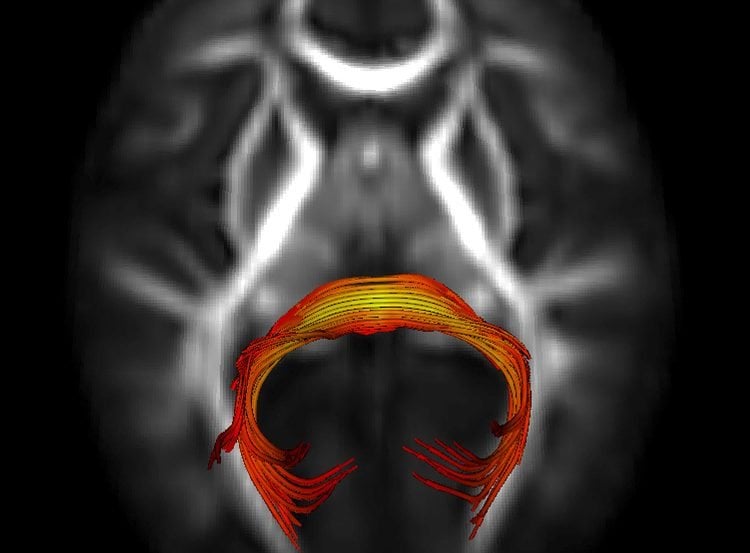 A brain scan is shown with a highlighted area