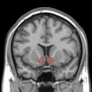 The image is an MRI scan of the brain with the nucleus accumbens highlighted.