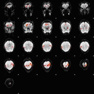 The image is an fMRI depiction of activated brain areas (BOLD) during an index finger-tapping sequence. 