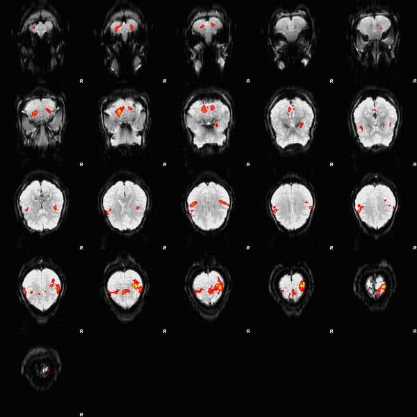 The image is an fMRI depiction of activated brain areas (BOLD) during an index finger-tapping sequence.