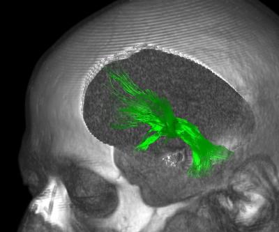 A brain image is shown with the medial forebrain highlighted.