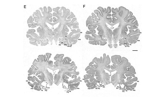 The image shows four brain slices with temporal lobe damage.