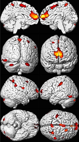The image shows MRI brain scans of adults exposed to lead as children.