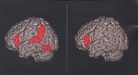The brain scan image shows the regions affected by dyslexia.