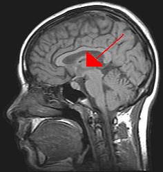 The image is a brain scan with an arrow pointing to the thalamus.