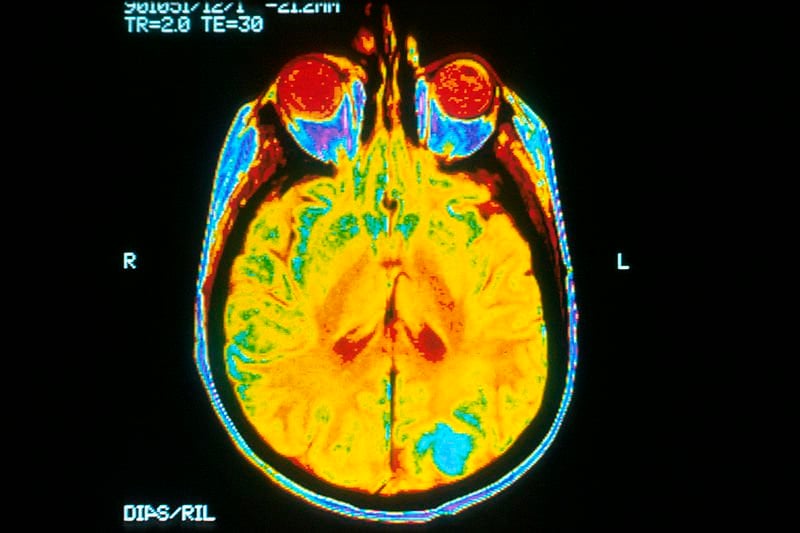 The image shows an MRI scan of a patient with brain cancer. The tumor is highlighted in blue.