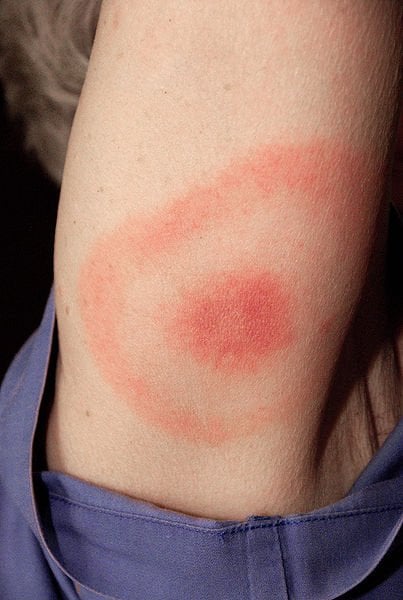 The image shows an erythema migrans "bulls eye" rash, which can be the first sign of a lyme infection.