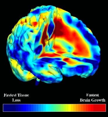 the image is a brain of MRI scan data for child onset schizophrenia showing areas of brain growth and loss of tissue.