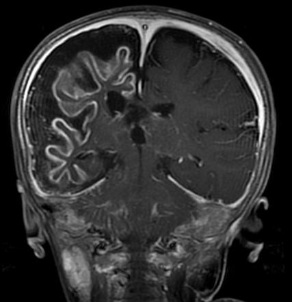The image shows a brain scan of a child with sturge-weber syndrome.