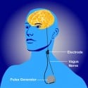 Nerve Stimulation for Severe Depression Changes Brain Function ...