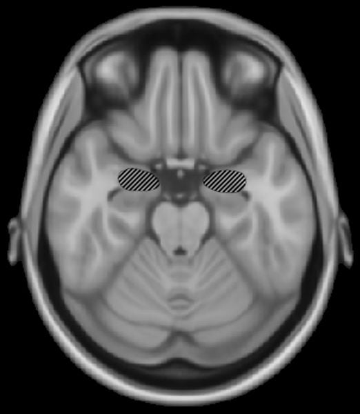 The MRI scan highlights the location of the amygdala