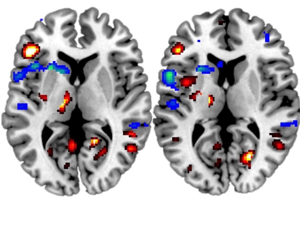 The image shows an fMRI of a participant with a stroke viewed performing actions mentioned in the research.