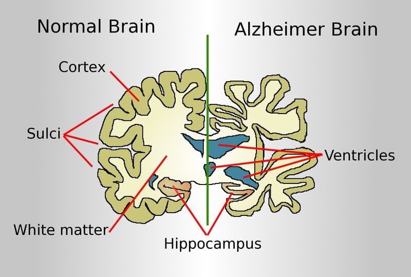 This illustration compares a normal brain to an alzheimer's brain.