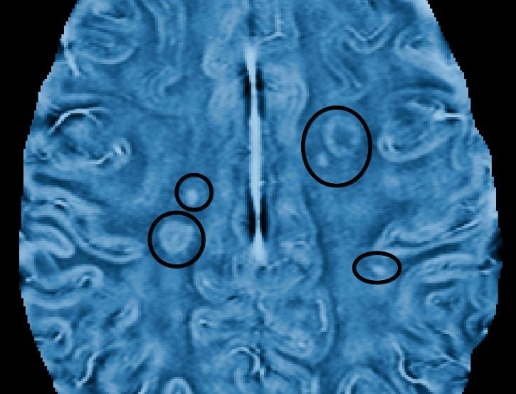 The image shows an mri brain scan of a patient with MS.
